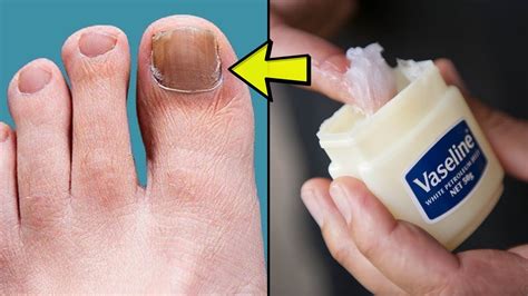 The fungus can spread to other areas of the hands or feet, and can be mild . . Can hand sanitizer kill toenail fungus